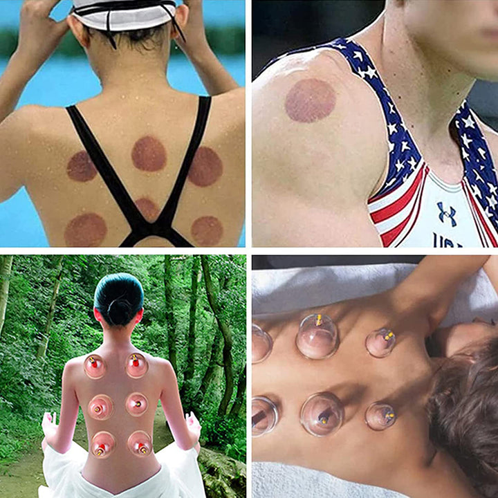 Premium Cupping Therapy Set – Vacuum Suction Cups for Massage, Anti-Cellulite, and Physiotherapy, Relieves Back, Neck